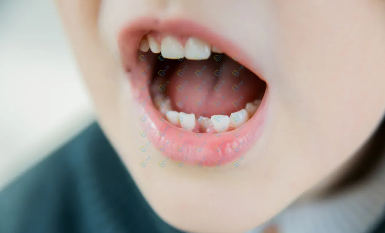 孩子好好的乳牙怎么越長越歪了呢？