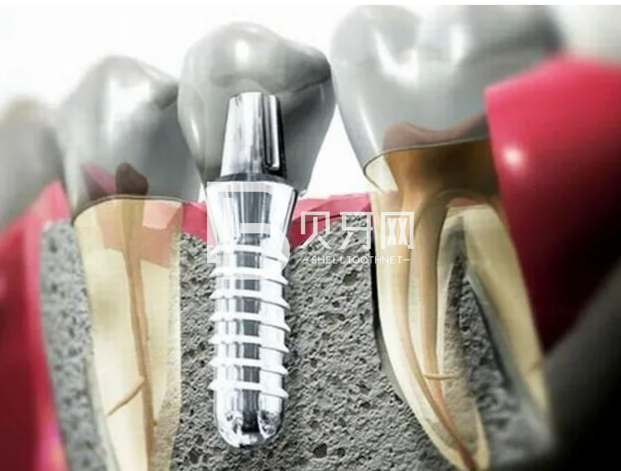 種植牙，真的很可怕嗎？