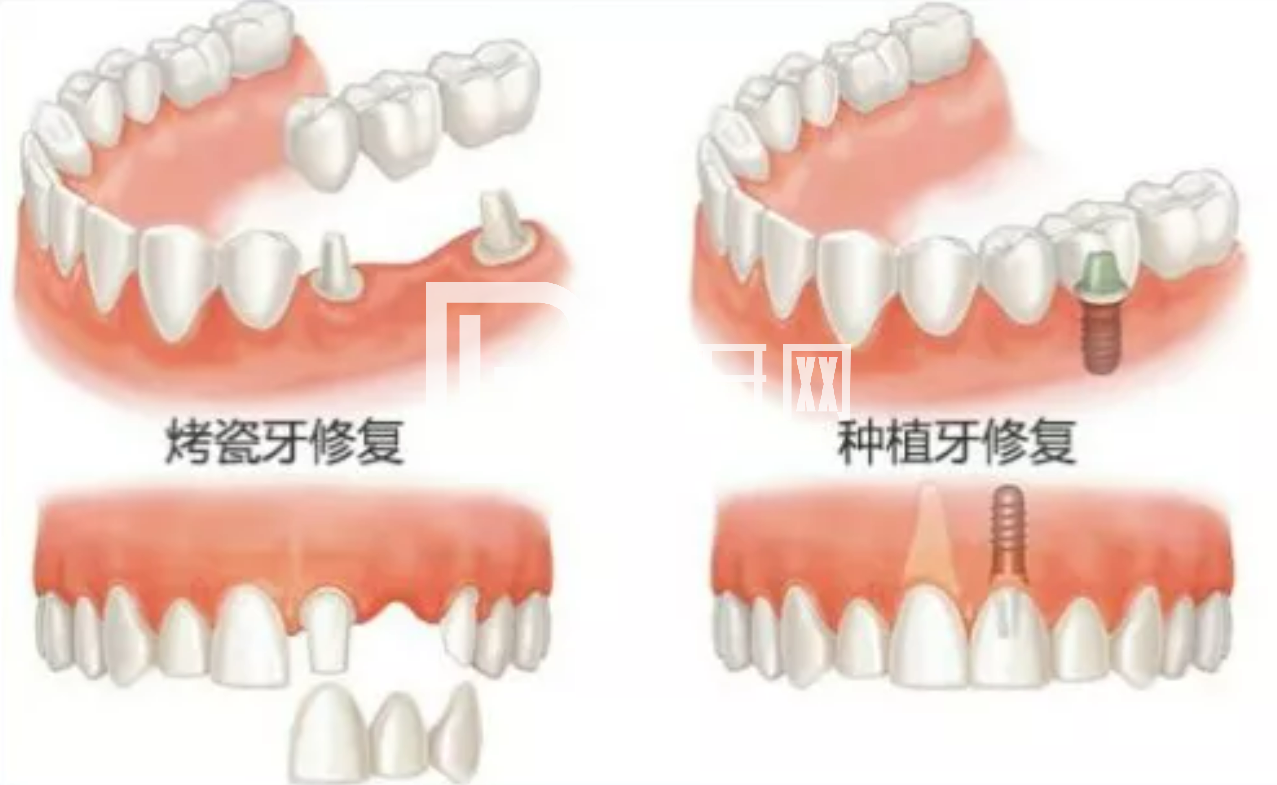 老人種牙對(duì)身體條件有要求嗎？