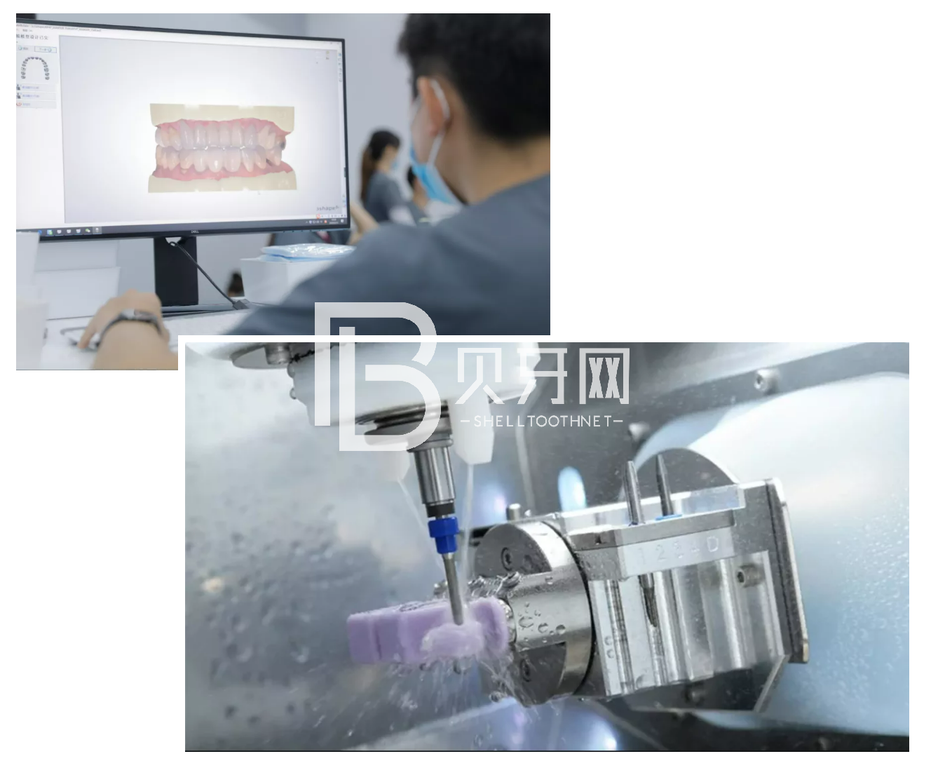 缺牙后最容易陷入的誤區(qū)，您中招了嗎？