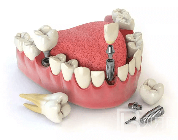 不到60歲，牙齒就所剩無幾了？這5件護(hù)牙小事，別等老了再做！