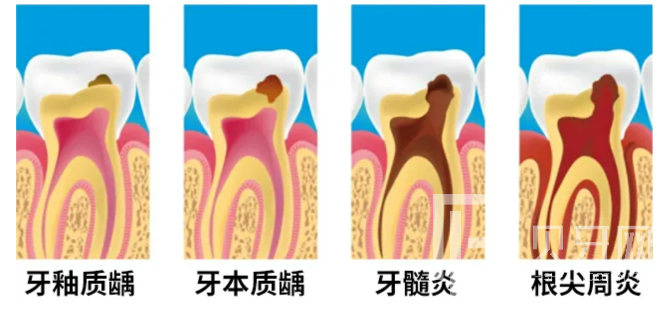 牙疼到無法入睡，我們該怎么辦？