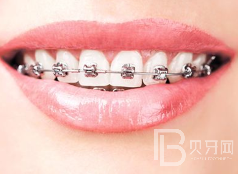 牙齒矯正有風(fēng)險(xiǎn)嗎？來聽聽口腔醫(yī)生怎么說