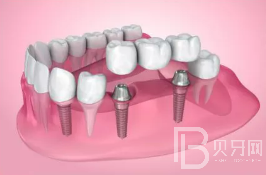 拔牙后一般多久能做種植牙？選什么植體比較好？