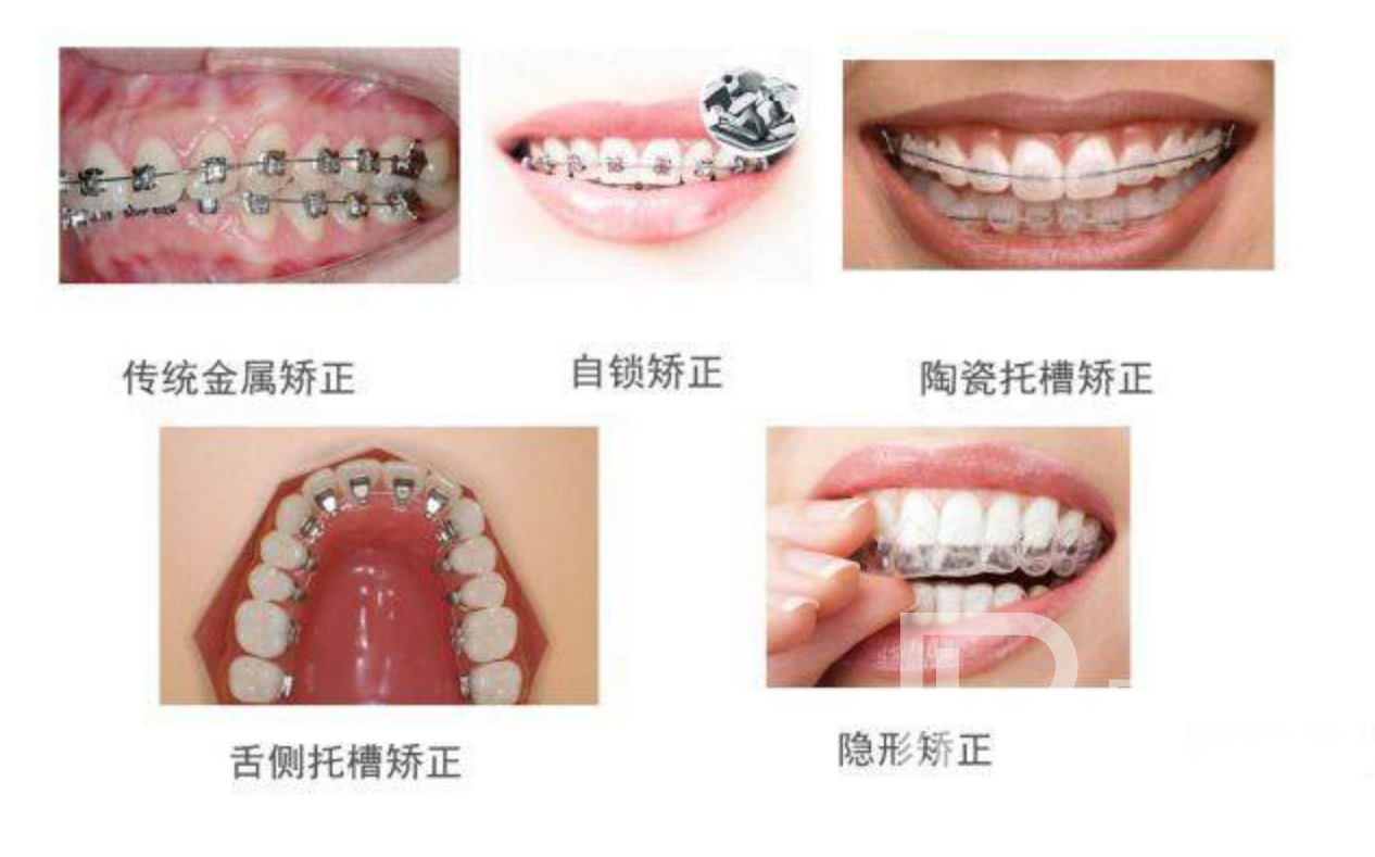 牙齒不整齊都有哪些矯正方式?分別價(jià)格多少錢(qián)？