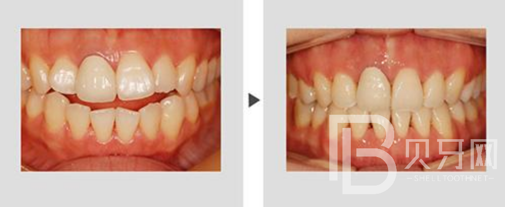 牙齒不齊一定要矯正嗎？還有哪些方式可以改變？