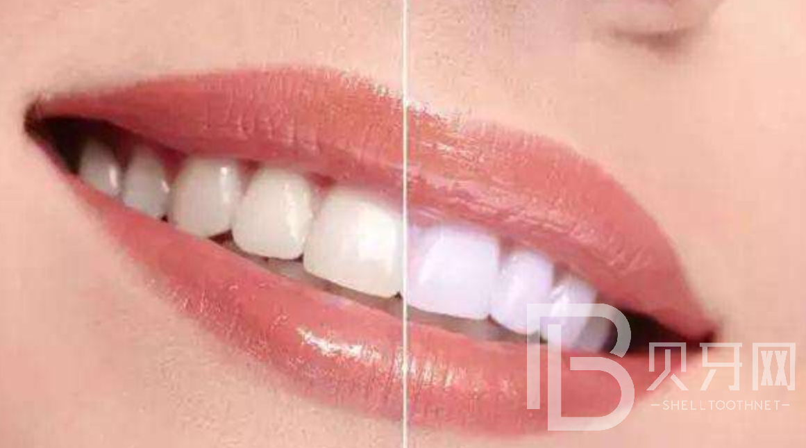 影響牙齒美白的六大食物，你知道是哪六種嗎？