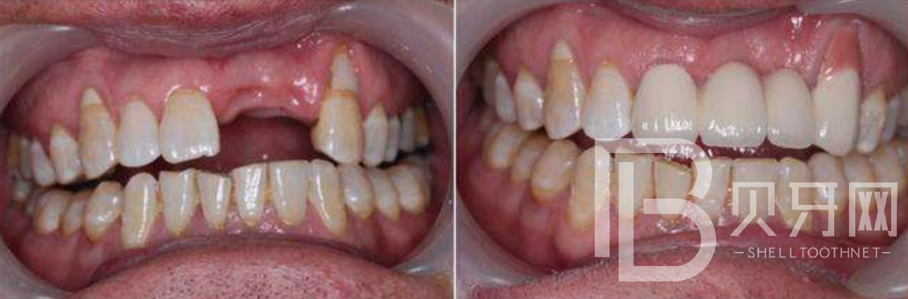 有牙周炎能不能做種植牙？