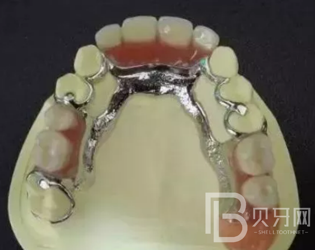 牙齒缺失一顆哪種修復方式好？