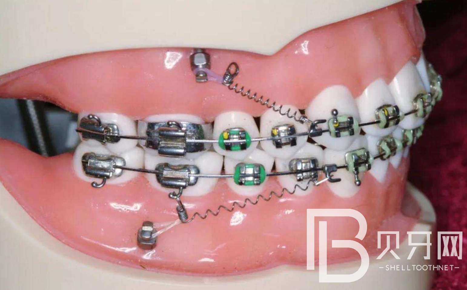 牙齒矯正多久才會有效果？牙齒矯正需要多長時(shí)間