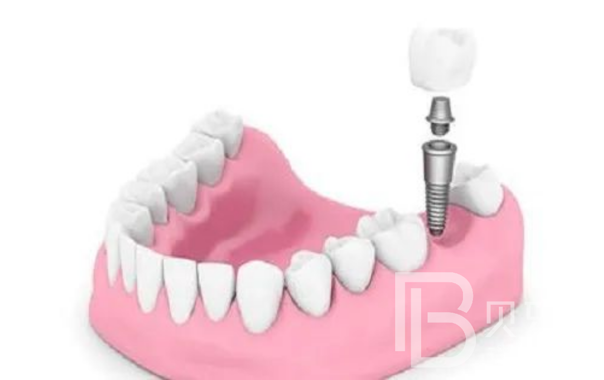 多顆牙缺失做種植牙需要多少錢？