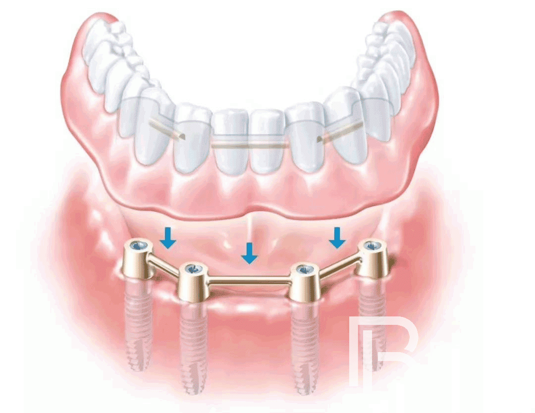 種植牙知識科普：All-on-4種植牙的幾個(gè)常見問題！