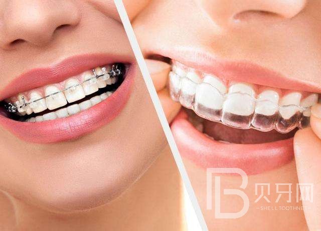 牙齒矯正有沒有年齡限制，牙齒矯正的黃金年齡