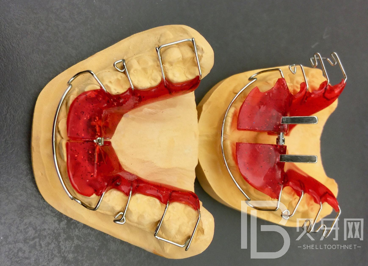 牙齒矯正后怎么樣保持才不會反彈？