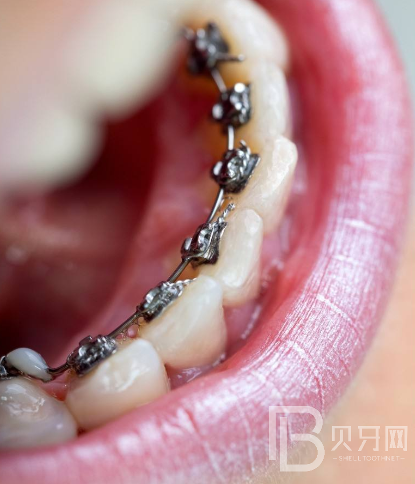 牙齒矯正后要注意什么？聽聽牙醫(yī)怎么說
