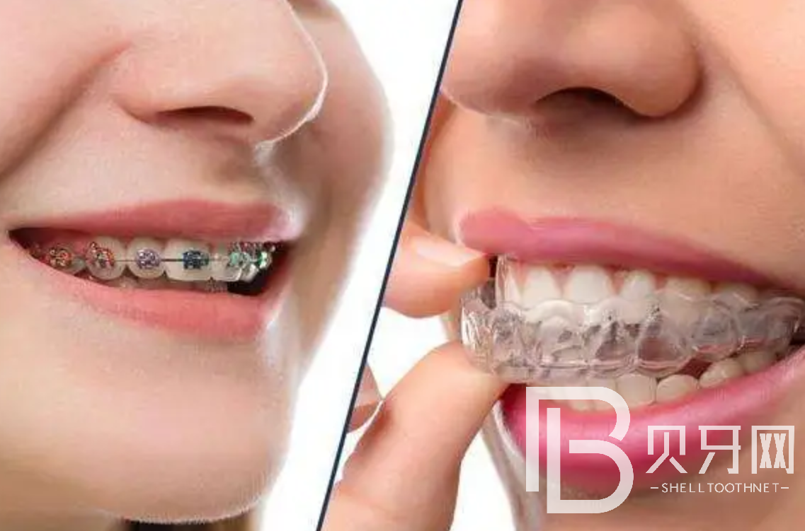 金屬矯正和隱形矯正應(yīng)該怎么選擇