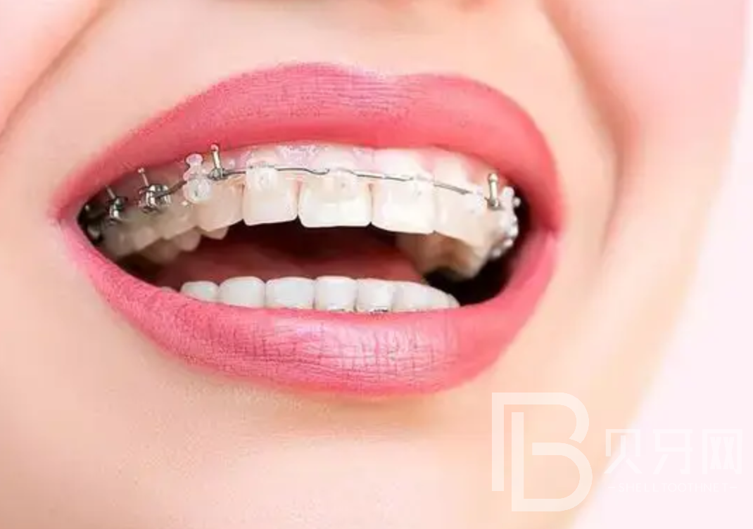 隱形牙套、鋼托槽、陶瓷托槽有什么區(qū)別？