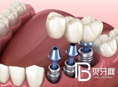 北京荷馬口腔看牙很貴嗎？醫(yī)院價(jià)格表告訴你實(shí)情！