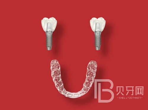 上海成人牙齒矯正大概價(jià)格多少錢，費(fèi)用價(jià)格都是怎么算的