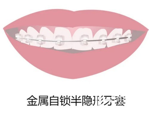 上海牙齒矯正價(jià)格表揭秘 五千到五萬都有就看你怎么選擇！