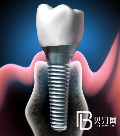 北京種植牙的價(jià)格表公布：看看在北京種牙哪里便宜！