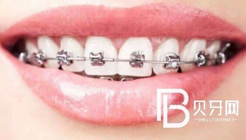 北京牙齒矯正比較好的醫(yī)院有哪些？矯正費(fèi)用需要多少？