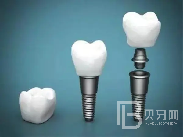 北京西爾口腔醫(yī)院種植牙價格表落地