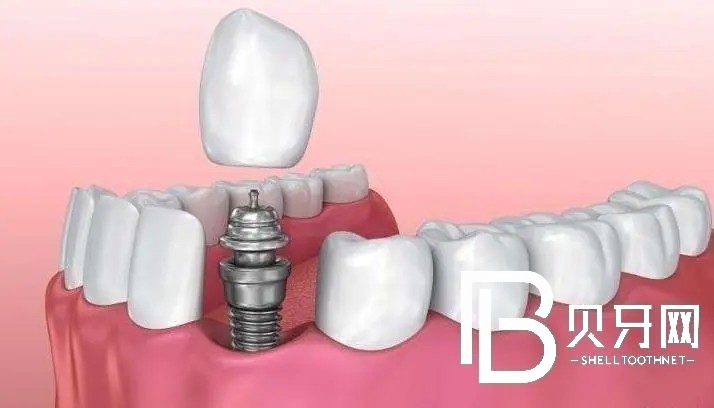 上海美冠塔口腔好不好？種植牙技術(shù)怎么樣？