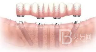 北京中諾口腔all-on-4種植牙的利與弊
