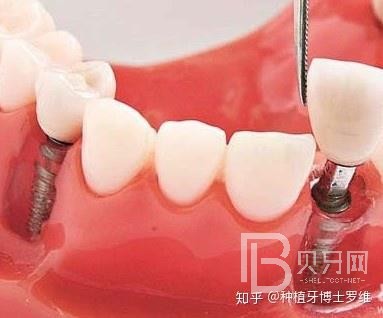 種植牙怎么樣？看看深圳諾德口腔怎么說！