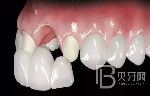 深圳友睦口腔4顆種植牙連冠好還是單冠好