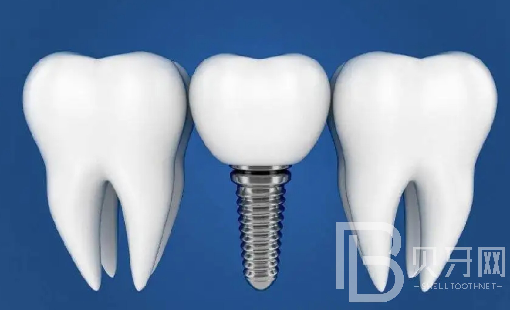 半口種植牙大概要幾次完成？北京美冠塔口腔種植牙怎么樣？
