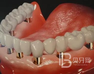 廣州廣大口腔老年人種植牙價(jià)格，全口種植牙需要種幾棵