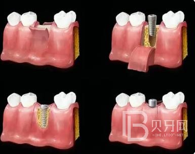 廣州圣貝口腔口碑好不好？靠譜嗎？70歲的老年人可否種植牙