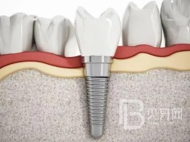 廣州德倫口腔種植牙多少錢？廣州德倫口腔矯正多少錢 ？廣州德倫口腔價(jià)格一覽表！