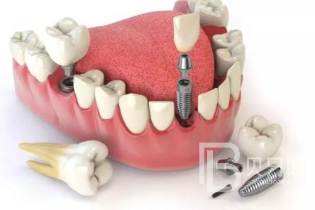 廣州拜博口腔口碑好不好？靠譜嗎？廣州拜博口腔種植牙多少錢