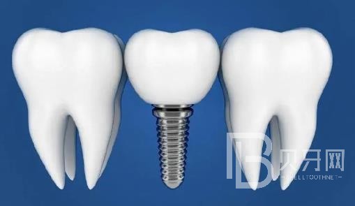 廣州瑞爾口腔老年人能做種植牙嗎？廣州瑞爾口腔價(jià)格多少錢