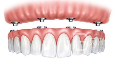 即刻種植牙好還是3月后種植好？北京德貝口腔種植牙怎么樣？