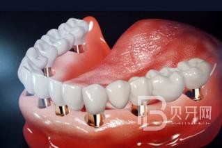 半口種植牙要種幾顆？北京維樂口腔正規(guī)嗎？