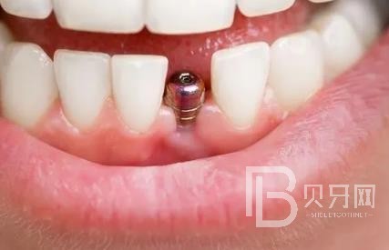 廣州暨博口腔怎么樣？廣州暨博口腔口碑好不好？廣州暨博口腔種植牙價格