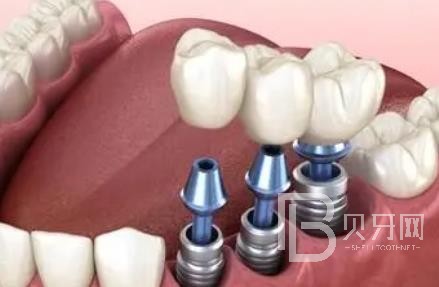 廣州諾爾口腔怎么樣？廣州諾爾口腔種植牙一顆多少錢