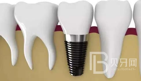 廣州曙光口腔正規(guī)靠譜嗎？醫(yī)院位置在哪？廣州曙光口腔種植牙價格