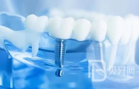 廣州友睦口腔怎么樣？廣州友睦口腔口碑好不好？廣州友睦口腔種植牙價(jià)格