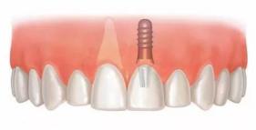 老年人適合的種植牙？北京諾美口腔怎么樣？