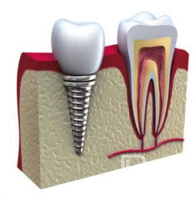 廣州德祥口腔怎么樣？廣州德祥口腔口碑好不好？廣州德祥口腔種植牙價格