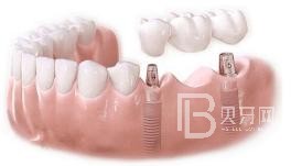 75歲老人適不適合做種植牙？北京圣貝口腔怎么樣？