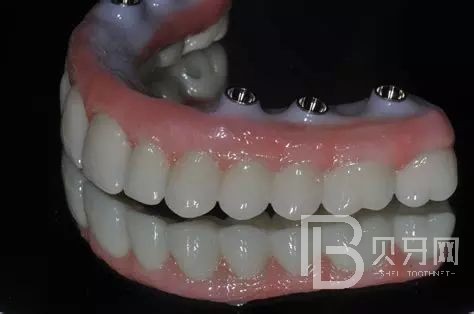 全口種植牙的利與弊都有哪些？北京拜博口腔正規(guī)嗎？