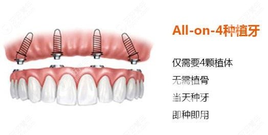 滿口種植牙需要種幾顆？北京佳美口腔正規(guī)嗎？