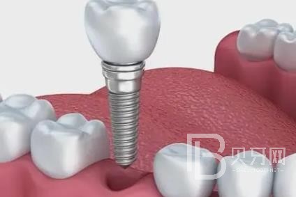 廣州愛威白口腔怎么樣？廣州愛威白口腔口碑好不好？廣州愛威白口腔種植牙價格