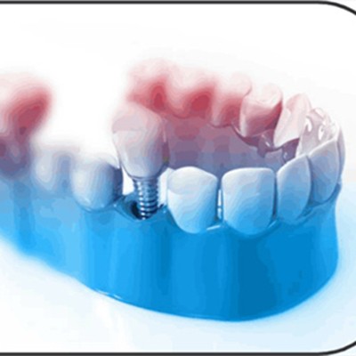 寧波種植牙價(jià)錢！寧波江北康樂口腔門診部種植牙價(jià)格被打下來了，國產(chǎn)常州創(chuàng)英種植牙：3873元起/顆！
